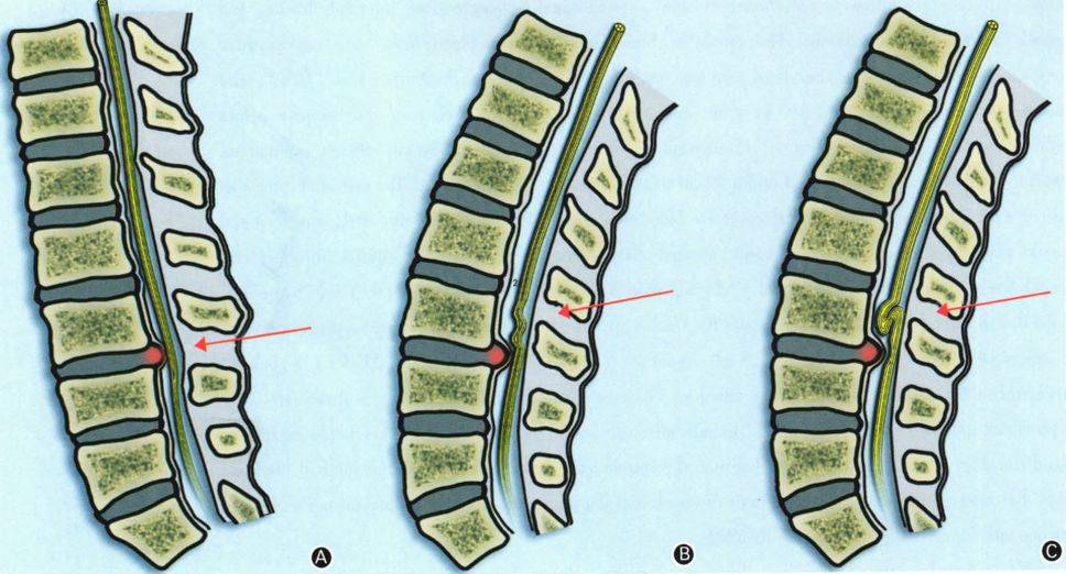 当中央椎管狭窄到一定程度时,硬膜囊受压变窄,卡压其内的马尾神经