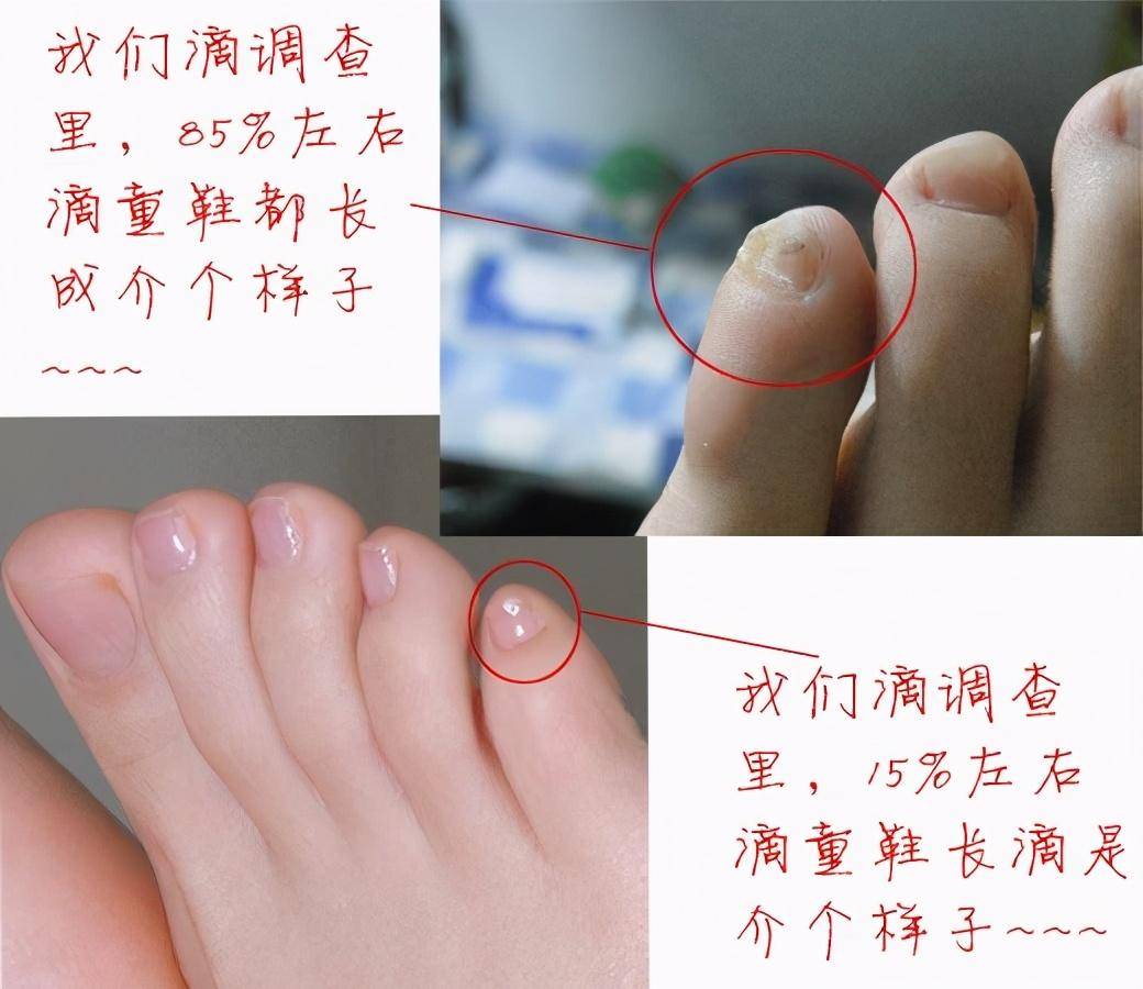 小脚趾指甲分成两瓣的人,他们究竟是从哪来的?