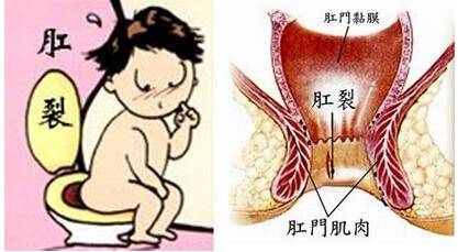 排便别太用力,肛裂可无法自愈_肛门