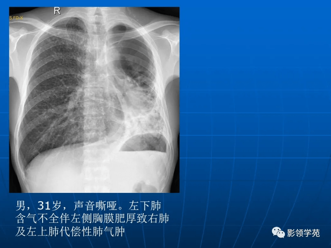 肺气肿的影像诊断