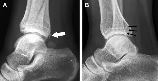 然而,后胫腓韧带牵拉引起的胫骨后踝骨折则很难发现.