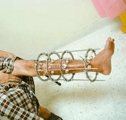 手术|杨幂关晓彤杠上了？撞衫尴尬就算了，还被网友喷做了直腿手术…