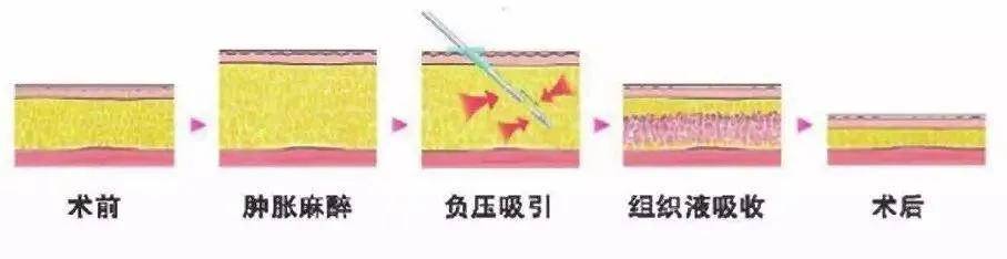 手术|杨幂关晓彤杠上了？撞衫尴尬就算了，还被网友喷做了直腿手术…