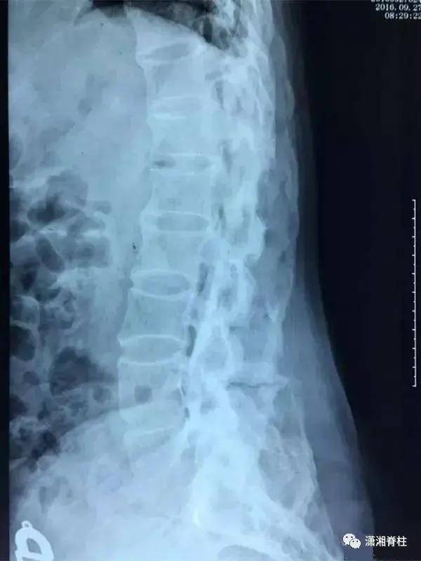 预防强直性脊柱炎灾难性的并发症:脊柱骨折并截瘫