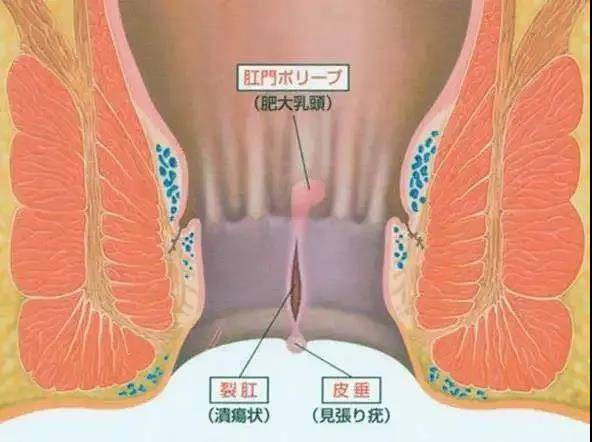 可以自愈吗?_肛门_肛管_局部