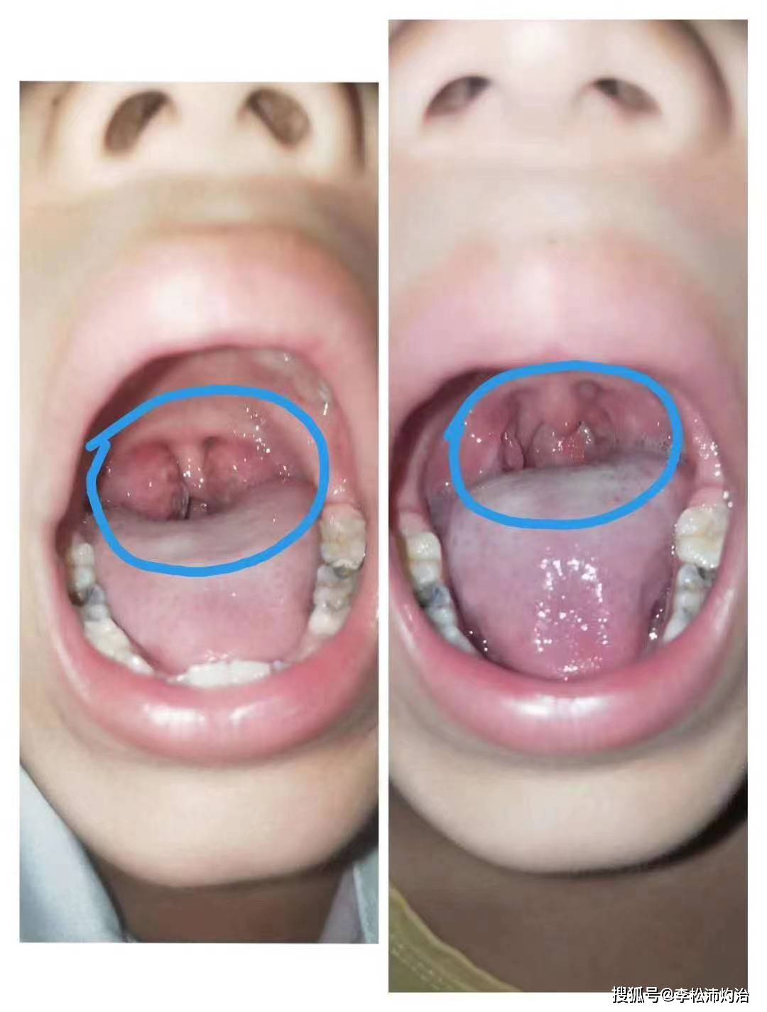 扁桃体灼烙术可以给孩子做吗?扁桃体灼烙法有危险吗?