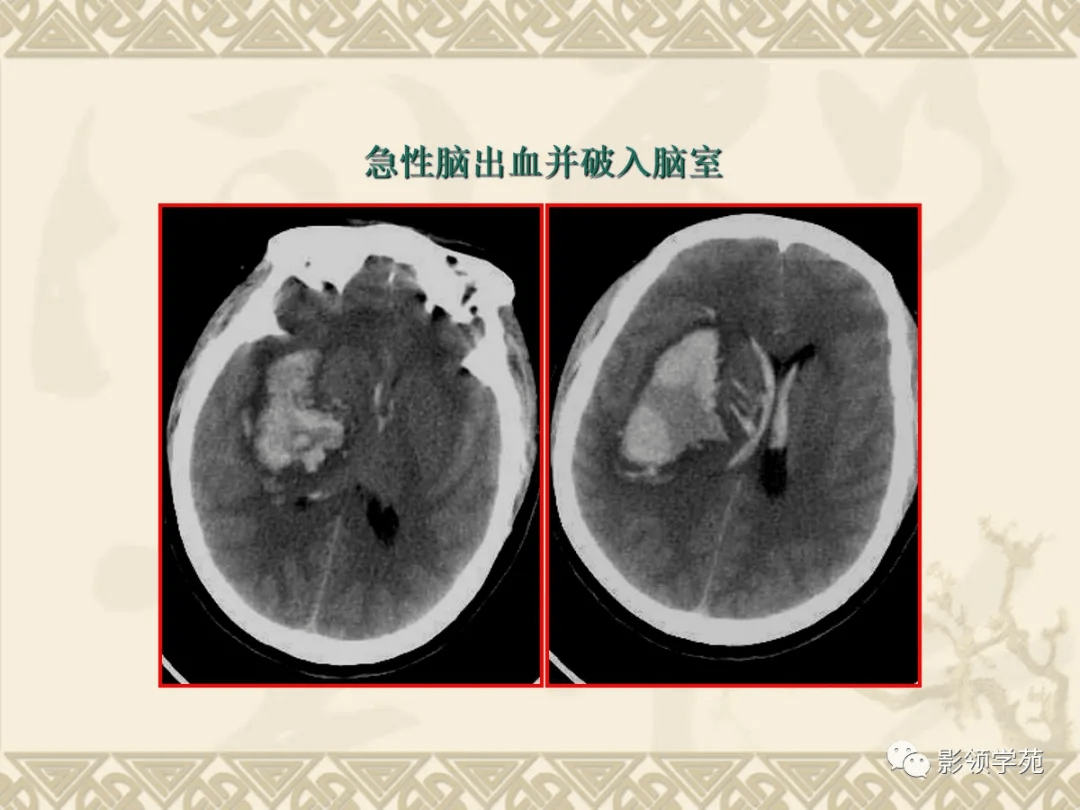 动脉出血性梗死大块脑梗死,脑软化急性脑梗塞基底节区腔隙性脑梗死多