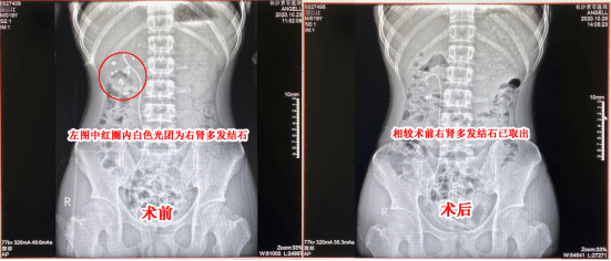 肾结石是属于什么病 1e5f93df10a94df7835739b79dede622.png