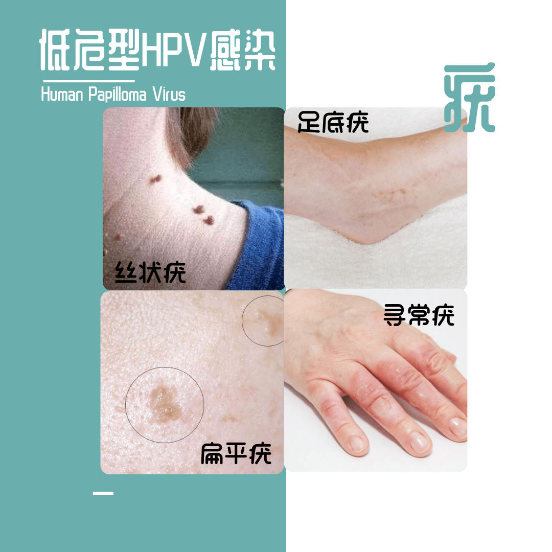 低危型hpv病毒虽然不会导致癌症,但是持续感染也会引发皮肤的疣变