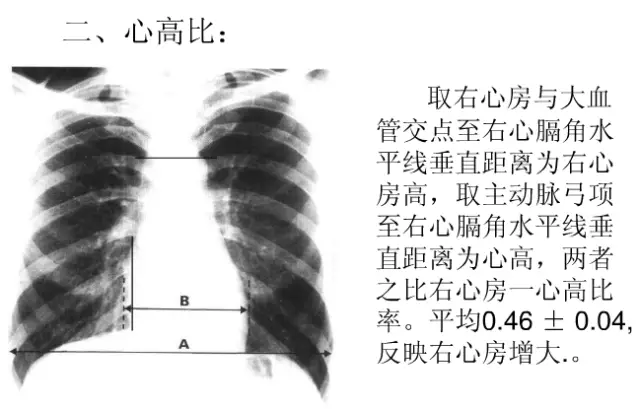 x线中的心影增大怎么解读