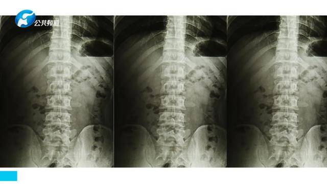 长江主任说脊柱骨质疏松症对脊柱的危害
