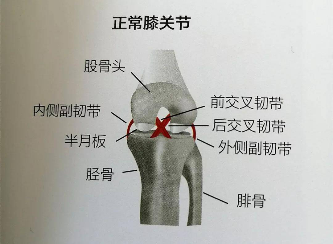 当膝关节来自外侧的暴力作用,小腿外展外旋等情况下,膝关节内侧副韧带