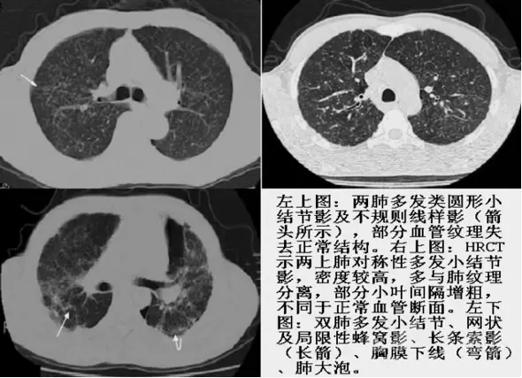 熟记这些 ct 表现,一眼识破转移性肺癌
