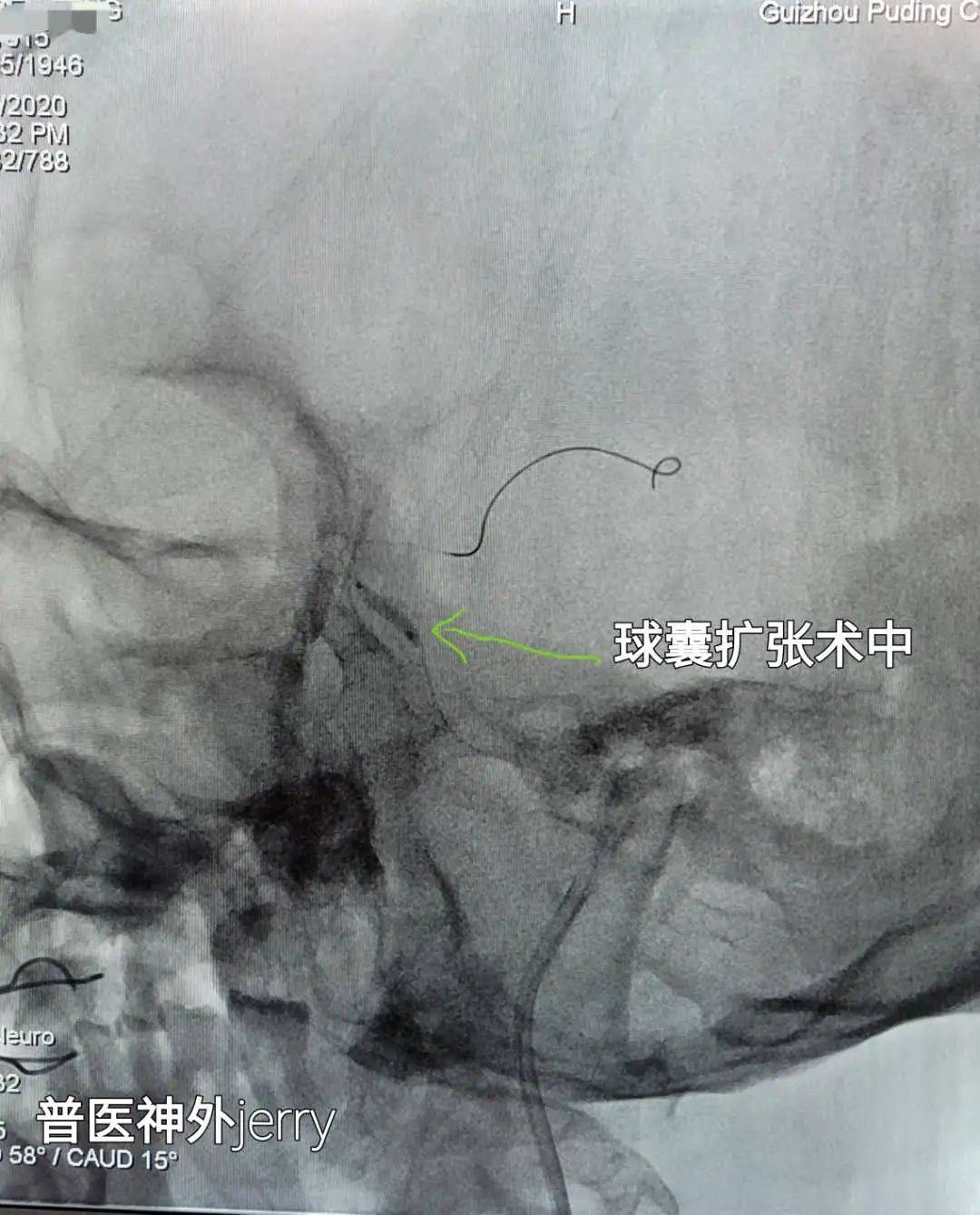 家属|卒中绿色通道，让生命跑过死神