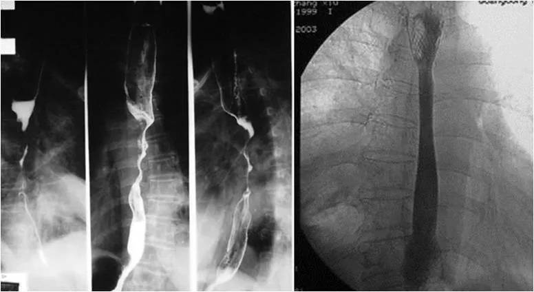 食管癌术后吻合口狭窄; ★食道癌术后复发; ★食管气管瘘,食管纵隔