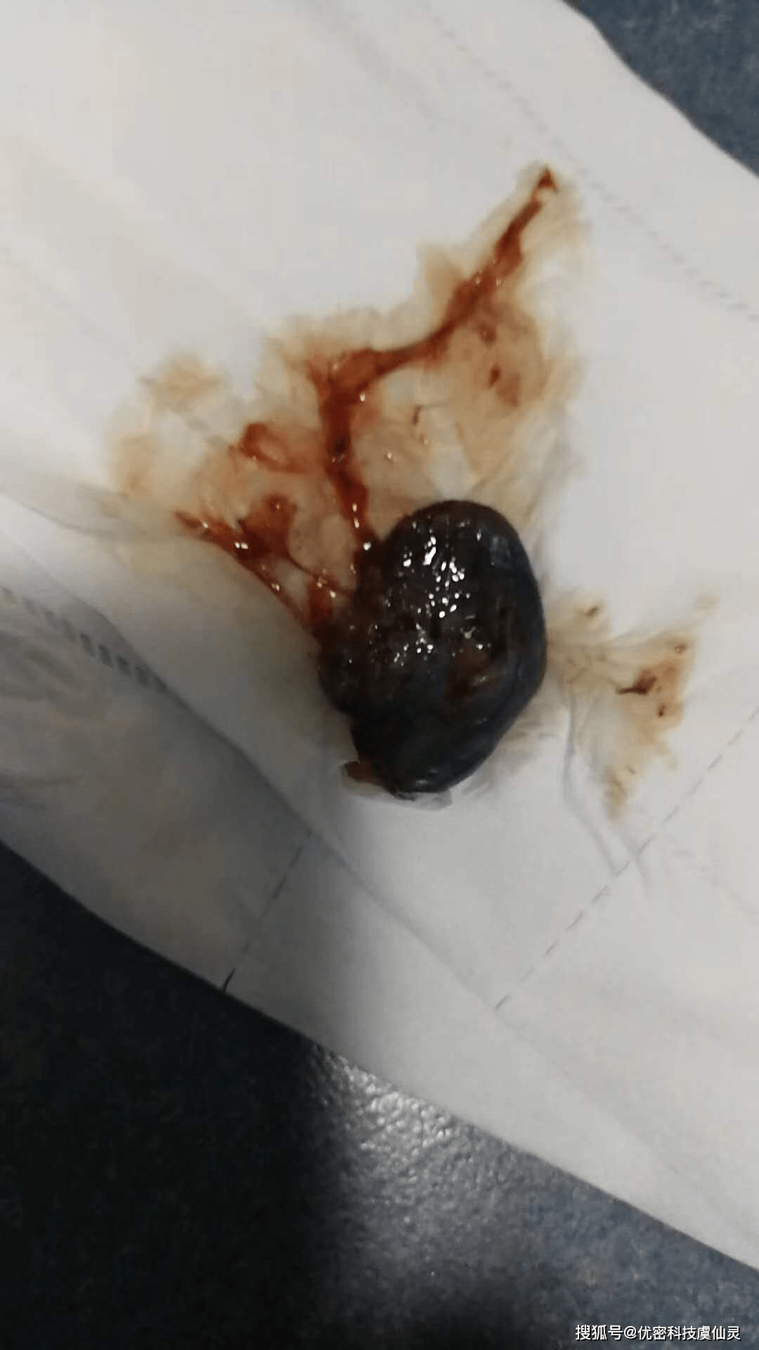 1,宫寒分泌物 4,宫颈纳囊 11, 流产后残留 责任编辑