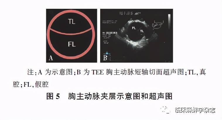 经食管超声心动图在非心脏手术中应用专家共识2020版