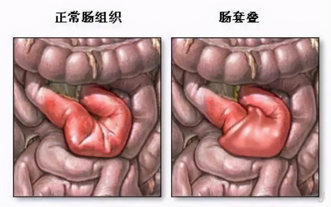 宝妈们:肠叠套不是肠绞痛,肠绞痛只是烦人,肠套叠却可