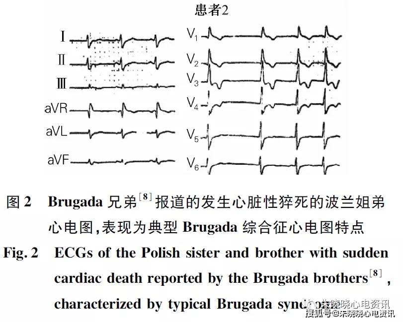 brugada综合征的发现与命名