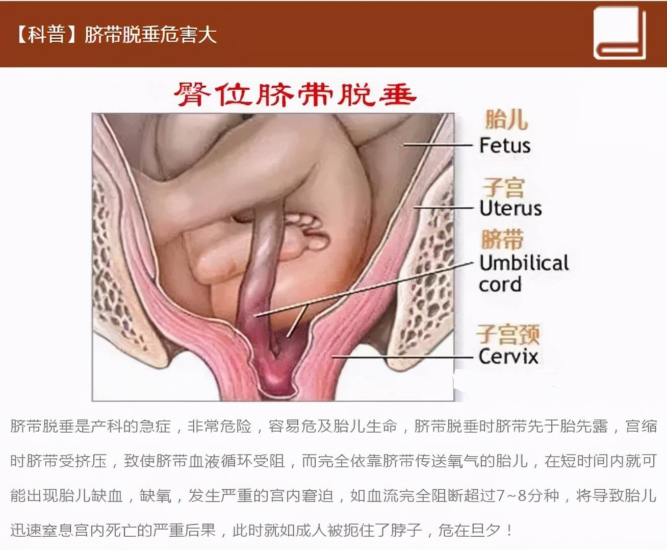 脐带|脐带脱垂 胎儿命悬一线 郑大三附院产科上演极速营救