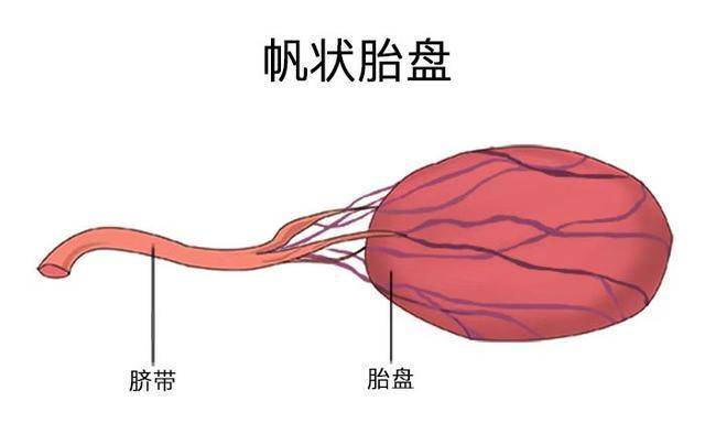 单脐动脉怎么办