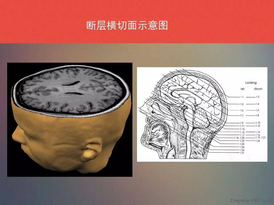 断层示意图一-图解 ●1,硬脑膜 ●2,头皮,皮下组织 ●3,额上回 ●4