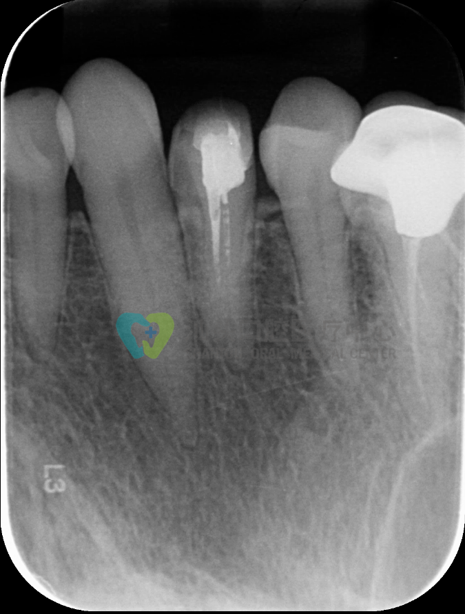 一例根管再治疗告诉你规范化操作有多重要