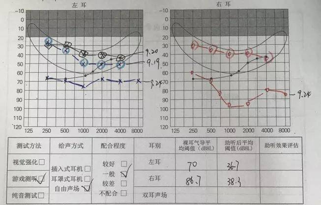 迟发性听力损失|警惕:新生儿听力筛查通过≠听力没问题!