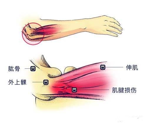 网球肘(肱骨外上髁炎)时肘关节外侧前臂伸肌起点处肌腱发炎疼痛.