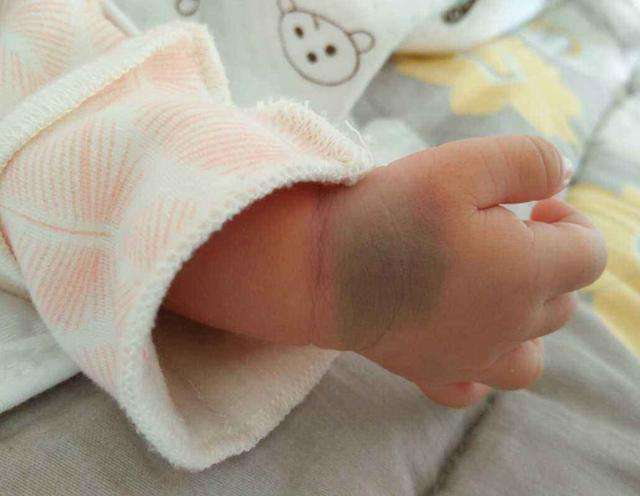 屁股|淘人精？”宝宝屁股“淤青”的秘密，你知道多少？“屁股青