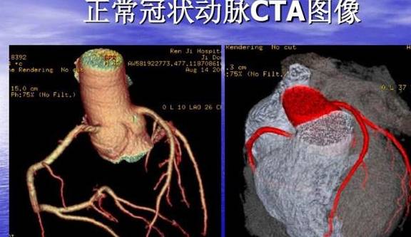 什么情况才需要做心脏造影 2bff0a6b108f4df99f6772a1da3c4adc.jpeg