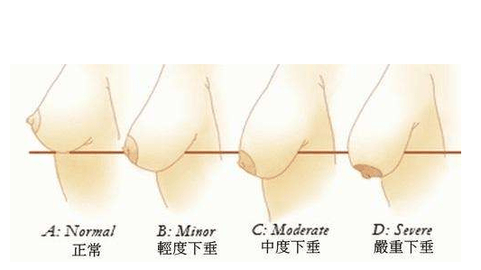 乳房为什么会下垂?_胸部