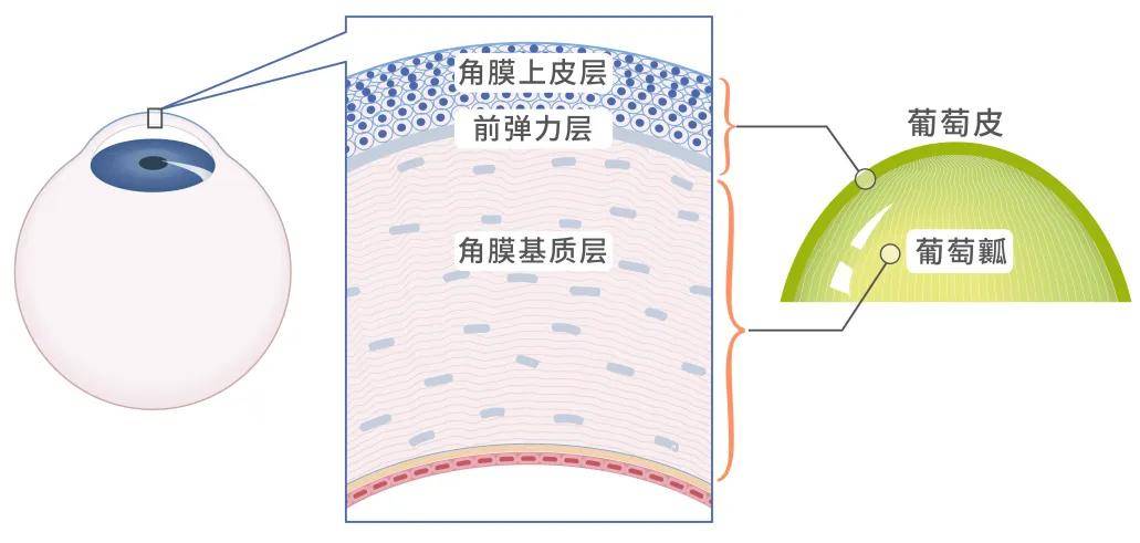 为了便于理解,请把「上皮层」和「前弹力层」想象成葡萄皮,把「基质层