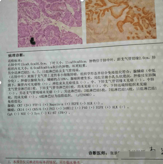 记住肺癌细分病理类型的基因突变小偏好