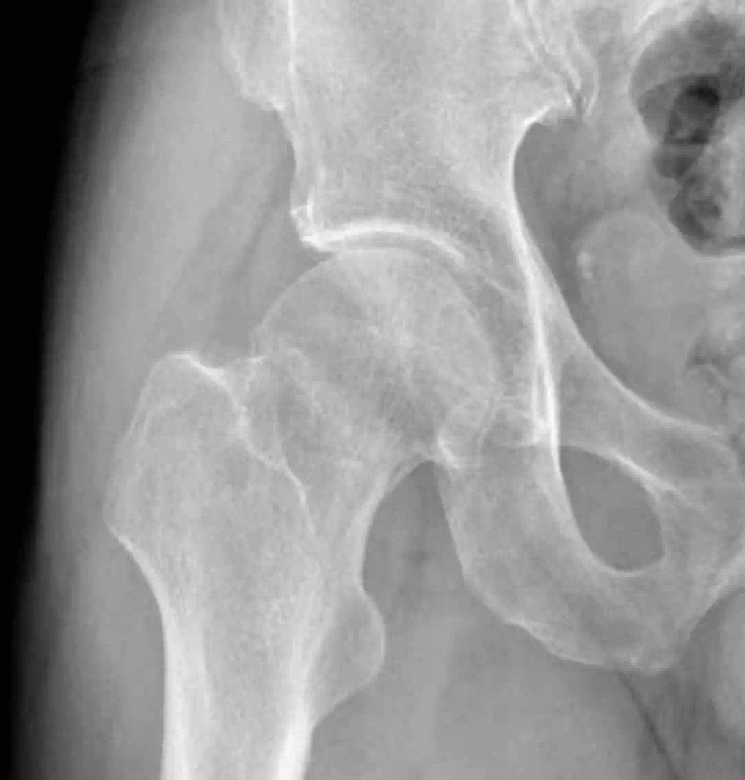 长春骨伤医院顺利为 84 岁高龄老人完成「左侧股骨粗隆间骨折闭合复位内固定手术」-医院汇-丁香园