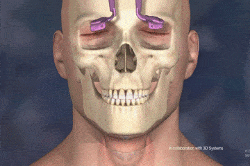 医生手术时，对病人切开的身体都做了什么？3D动画揭秘全过程（组图） - 6