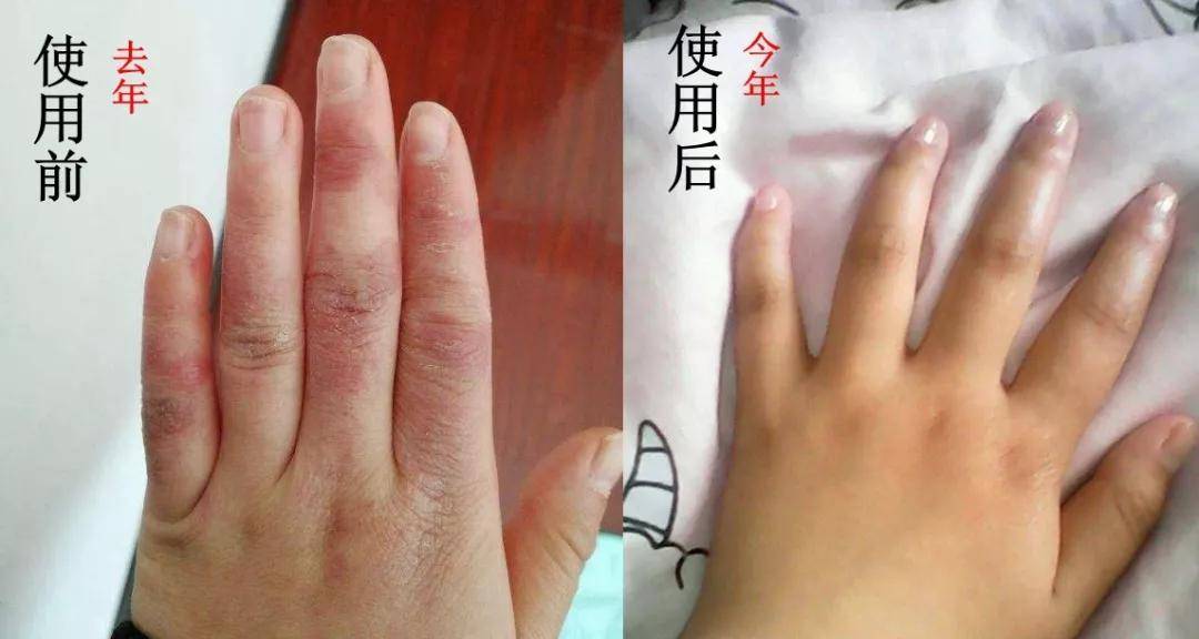 坐在硬板凳上,又没空调冬季手脚冰凉长冻疮的人的福音到了千万不要眨