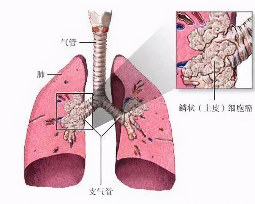 病情发展也比较慢,而且不像腺癌容易通过血行转移到其他脏器,肺鳞癌以