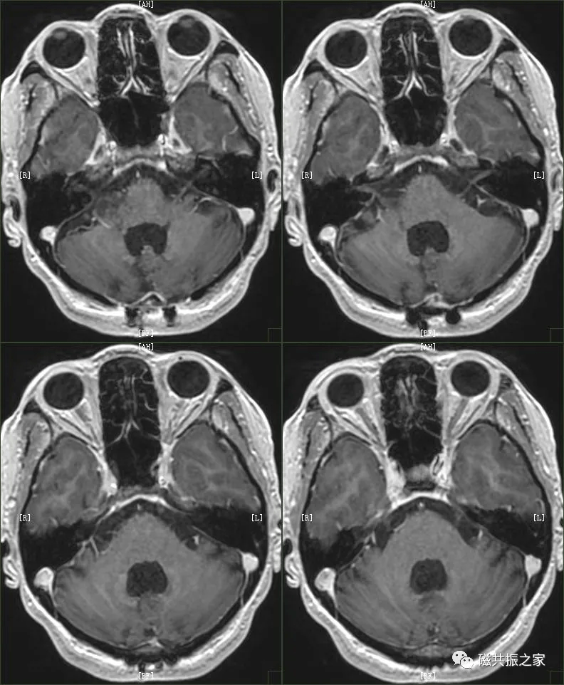 磁共振(mri)内耳扫描技术