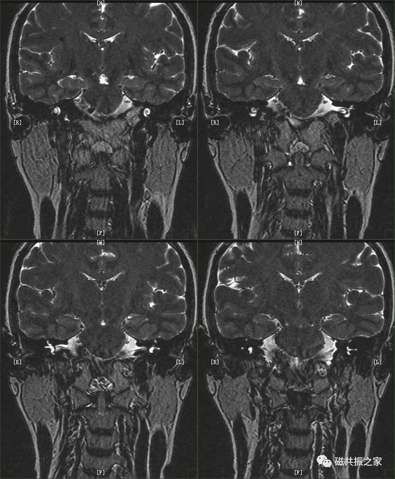 磁共振(mri)内耳扫描技术