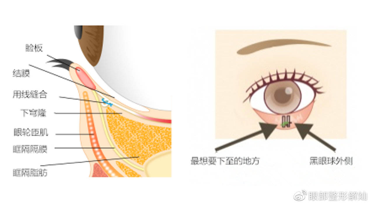 美之峰解灿,和你讲讲做眼整形的时候是否需要开下至