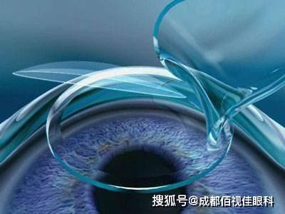 眼角膜是怎么消失的 8ee801a3ea8c4be78ca167fa5eb824ff.jpeg