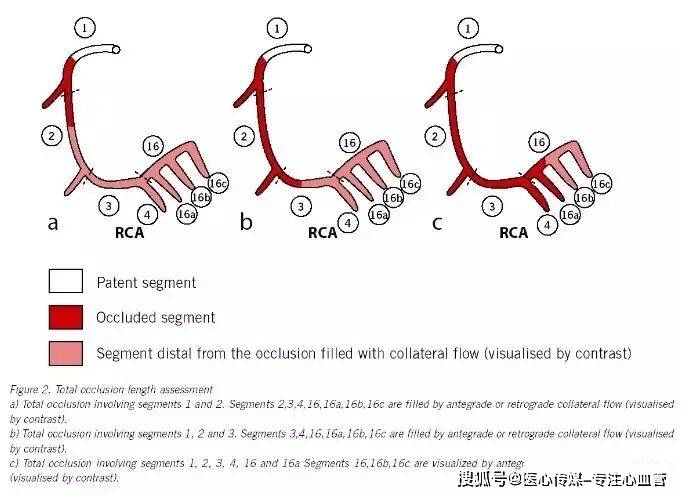syntax评分：选择pci或cabg？