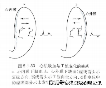 膜外电位为正,而缺血的心外膜心肌尚未复极.