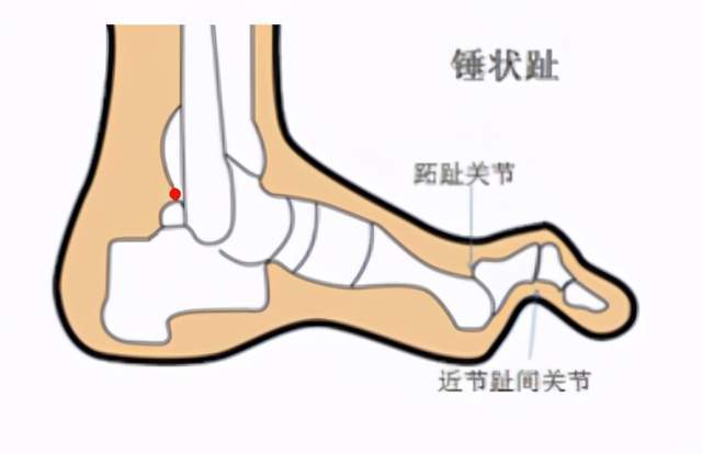 足趾畸形怎么办?_治疗