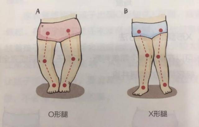 纠正o型腿:鞋垫内侧偏低,外侧偏高;纠正x型腿:鞋垫内侧偏高,外侧偏低.