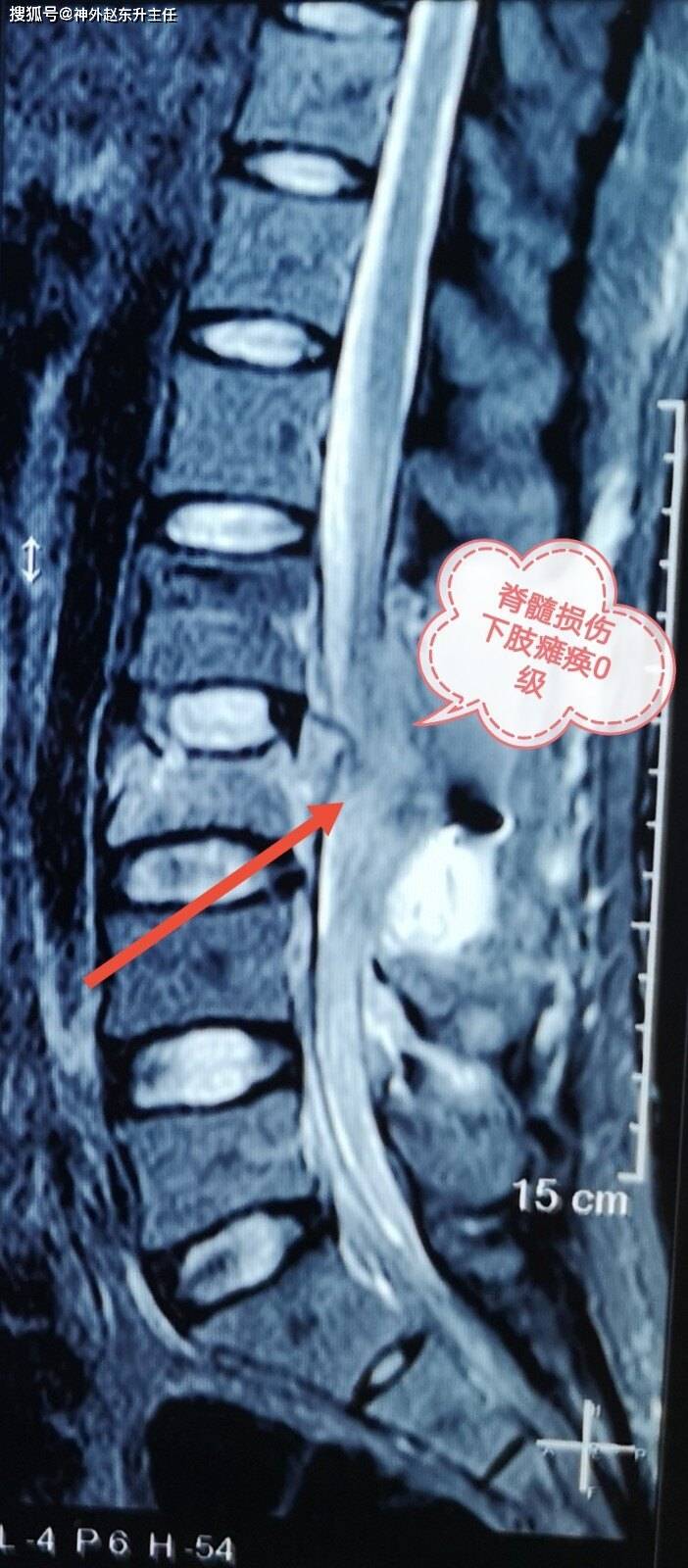 术后磁共振见脊髓损伤严重,边界不清