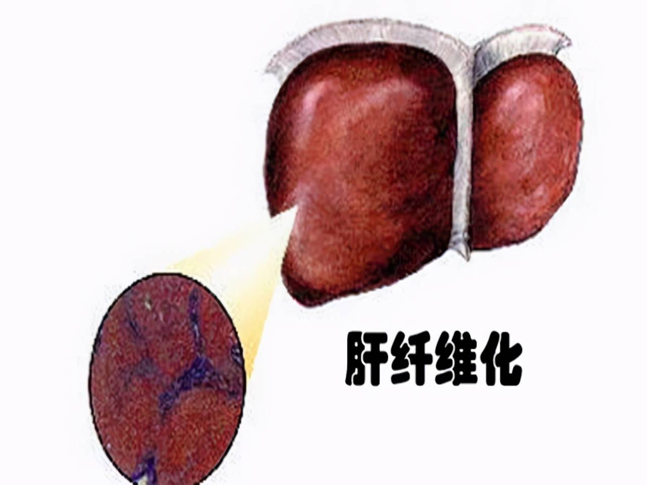 从肝纤维化到肝功正常,一位乙肝患者的抗病毒经历,结果值得借鉴