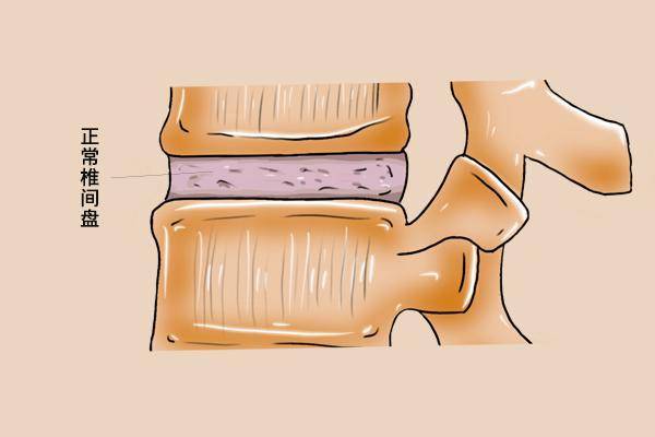 腰椎骨质增生和腰间盘突出的区别在哪里呢应该如何进行区分