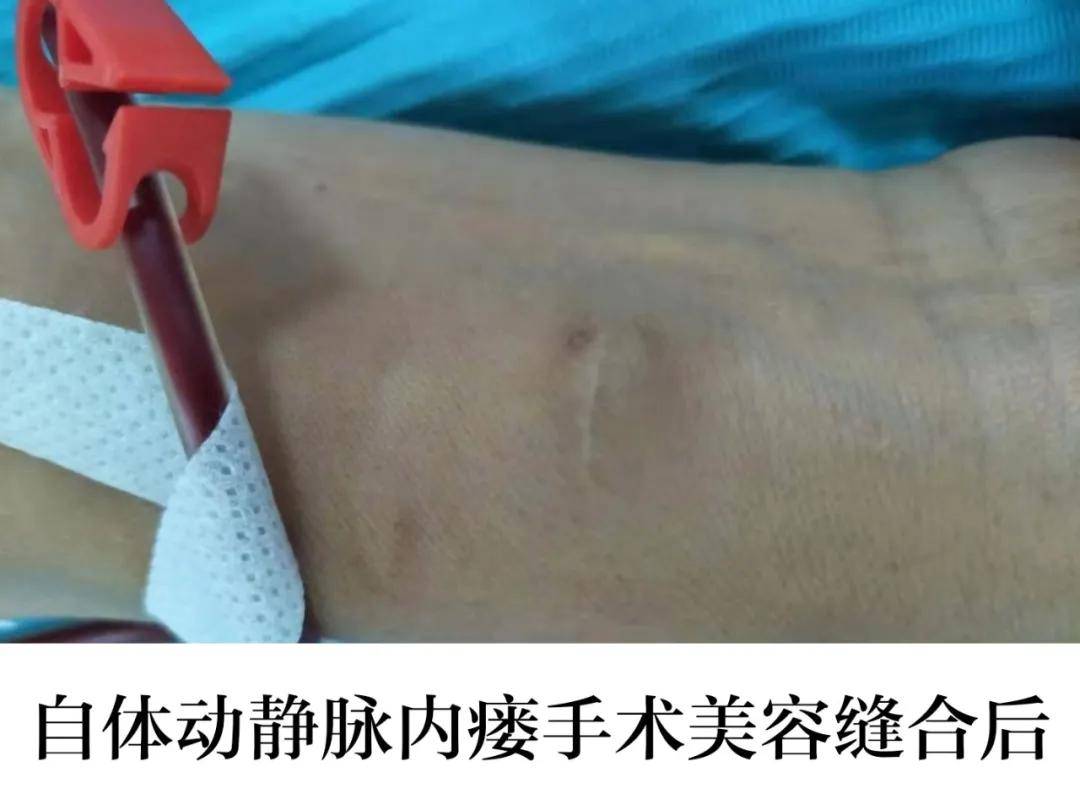 宿州中煤矿建总医院肾内科自体动静脉内瘘成形术:守护